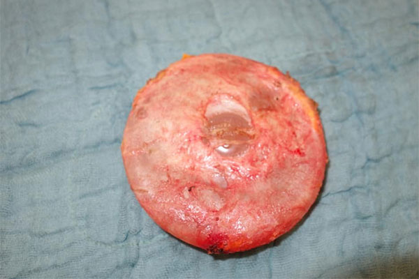 Implantat in dünner Kapsel (nach En bloc Entfernung)
