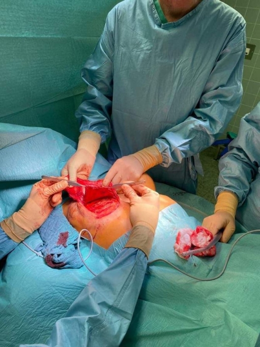 Blick in die Wundhöhle während Explantation