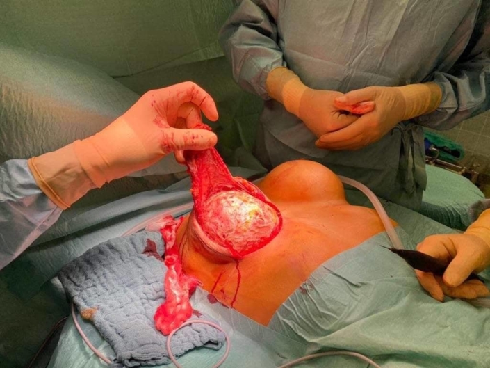 Blick auf die Kapsel während Explantation